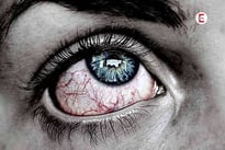 Syphilis im Auge: Zu viele Pornos geschaut?
