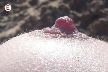 Areola
