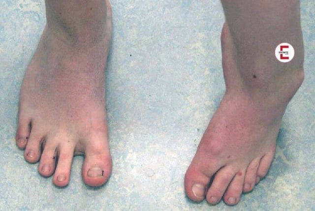 Frau mit Klumpfüßen verwöhnt Fußfetischisten