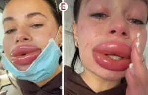Rubber Dinghy Lips Extreme: Nightmare Result Provides Shock