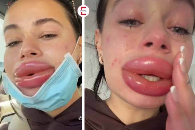 Rubber Dinghy Lips Extreme: Nightmare Result Provides Shock
