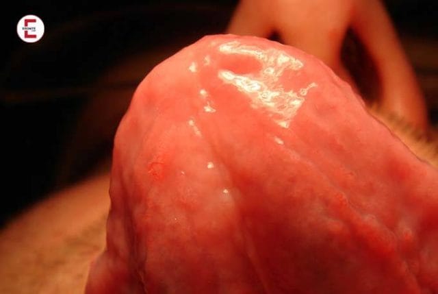 Zungenanal Zungenanal
